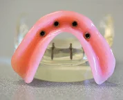 tit&aacute;n implant&aacute;tum