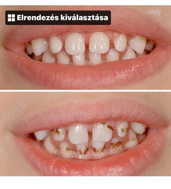 fogkőeltávolítás